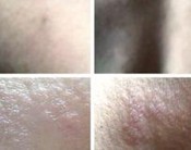 鱼鳞病的症状类型