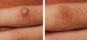 寻常疣治疗前后对比