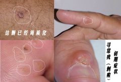 寻常疣的症状