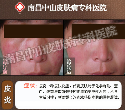 南昌中山皮肤病医院皮炎康复案例