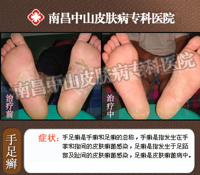 南昌中山医院手足癣治疗前后对比
