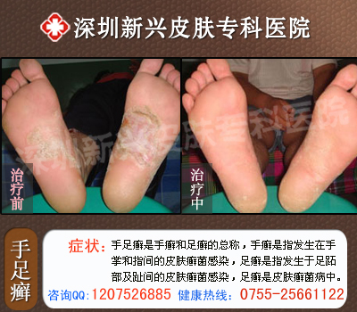 南昌中山皮肤病医院手足癣康复患者治疗前后