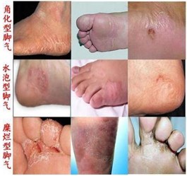 手足癣症状