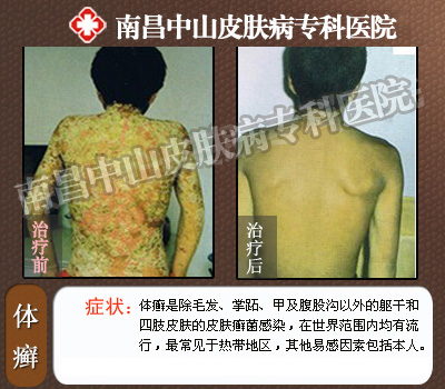 南昌中山皮肤病医院患者康复前后对比