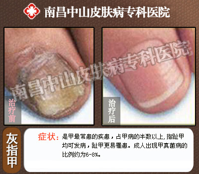 南昌中山皮肤病医院灰指甲治疗前后对比