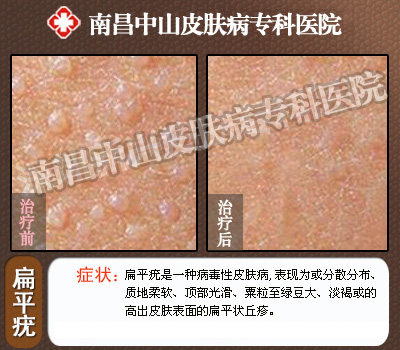 南昌中山皮肤病医院扁平疣治疗前后对比