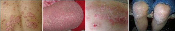 牛皮癣的常见症状