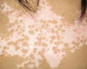 白癜风症状表现