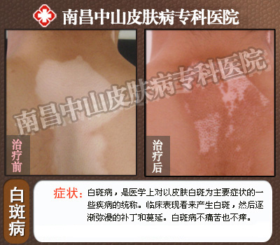 南昌中山皮肤病医院白癜风治疗前后对比