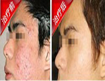 ðî´¯ÖÎÁÆÇ°ºó¶Ô±È