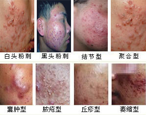 ðî´¯µÄÖ¢×´ÀàÐÍ