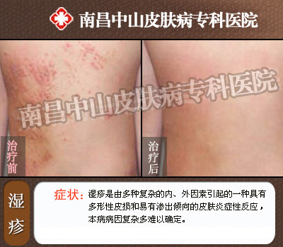 南昌中山皮肤病医院湿疹康复前后对比
