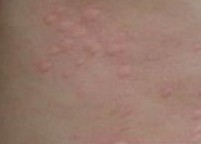 荨麻疹症状表现