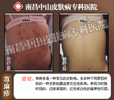 荨麻疹治疗前后对比