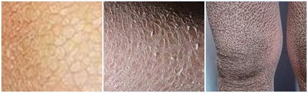 鱼鳞病的症状表现