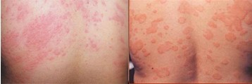 湿疹治疗前后对比