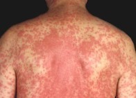 皮肤过敏常见症状