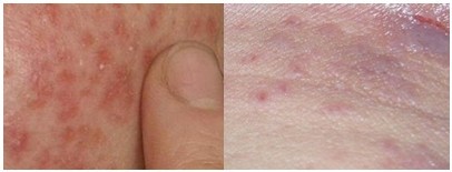 接触性皮炎治疗前后对比