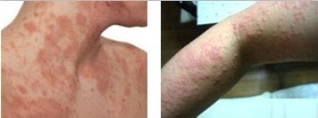 接触性皮炎治疗前后对比