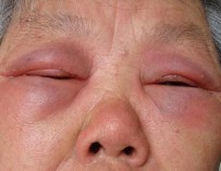 光敏性过敏症状