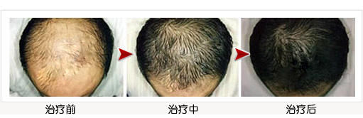 脱发的治疗变化过程