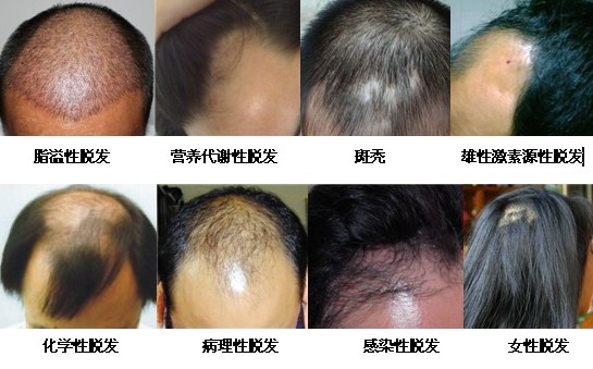 脱发的症状类型
