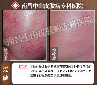 皮肤瘙痒治疗前后对比