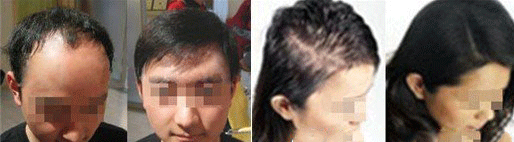 脱发治疗前后对比