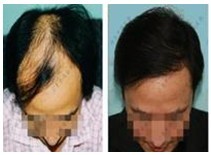 脱发治疗前后对比
