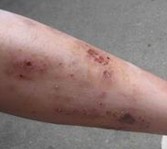腿部脚步湿疹症状