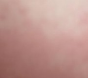 阴血不足型荨麻疹症状