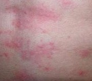 胃部感染性荨麻疹症状