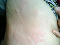 慢性荨麻疹症状