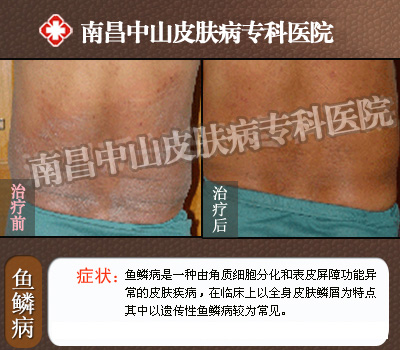南昌中山皮肤病医院鱼鳞病治疗对比