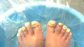 灰指甲的治疗方法