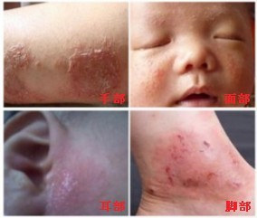 湿疹症状