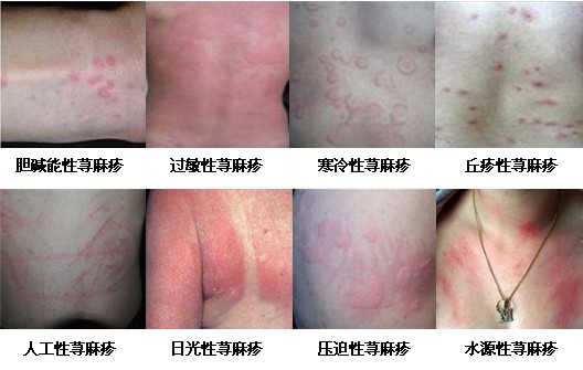 各类荨麻疹的治疗方法