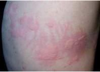 荨麻疹有什么症状表现