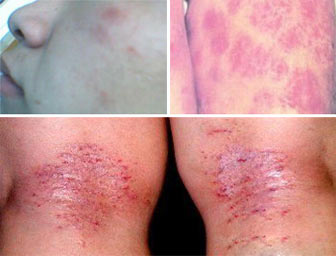 上海最好的皮肤病医院 上海江中医院