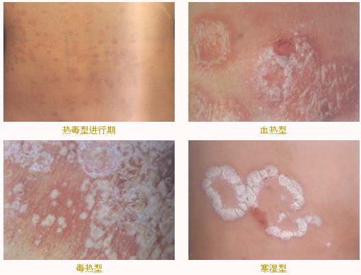 寻常型牛皮癣有哪些症状