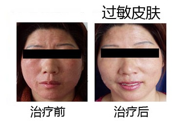 过敏性皮炎康复案例