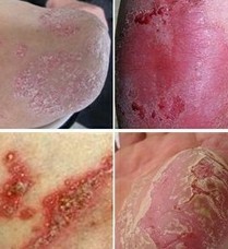 牛皮癣的危害和并发症介绍