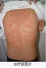 南昌牛皮癣正规医院专家介绍其危害是什么