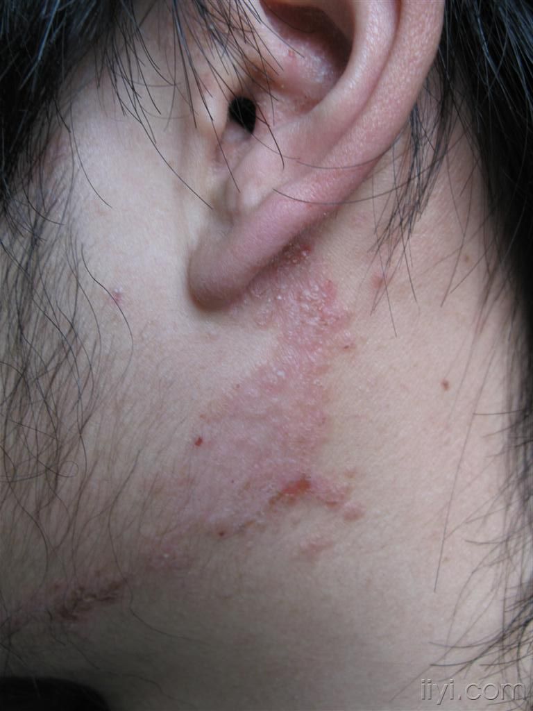 皮炎湿疹应该怎么治疗?