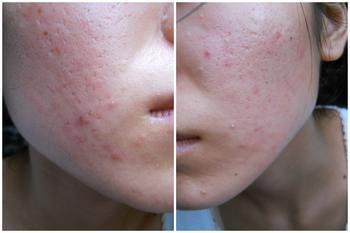 青春痘不治疗对生活的危害