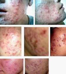 青春痘的后遗症