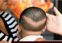 脱发的低龄化问题