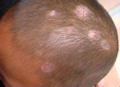 小儿体癣如何预防