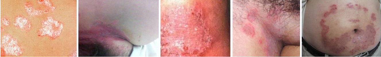 体癣的种类有哪些