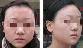 扁平疣治疗对比